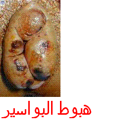prolapsus_hemorroidaire_en_arabe