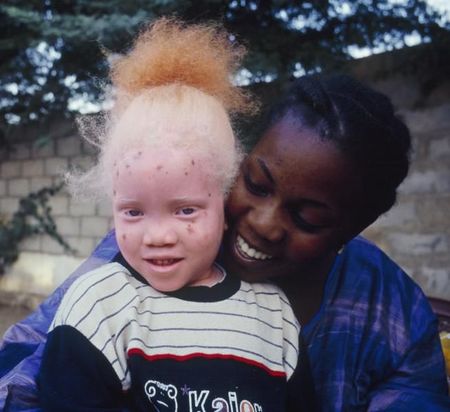 Albinos