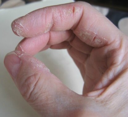 Crevasses aux doigts , comment les soigner - Soin Crevasse
