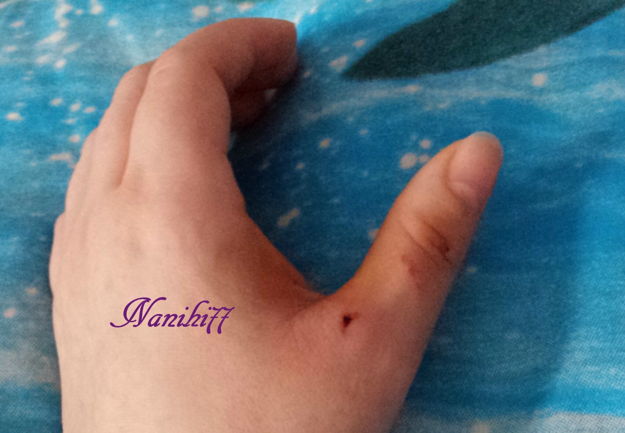 La Guérison De Ma Main Papotages Dune Assitante